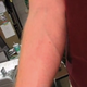 Image for article titled Man Gives Himself A Tattoo By Letting 1,000 Bed Bugs Feed On Him